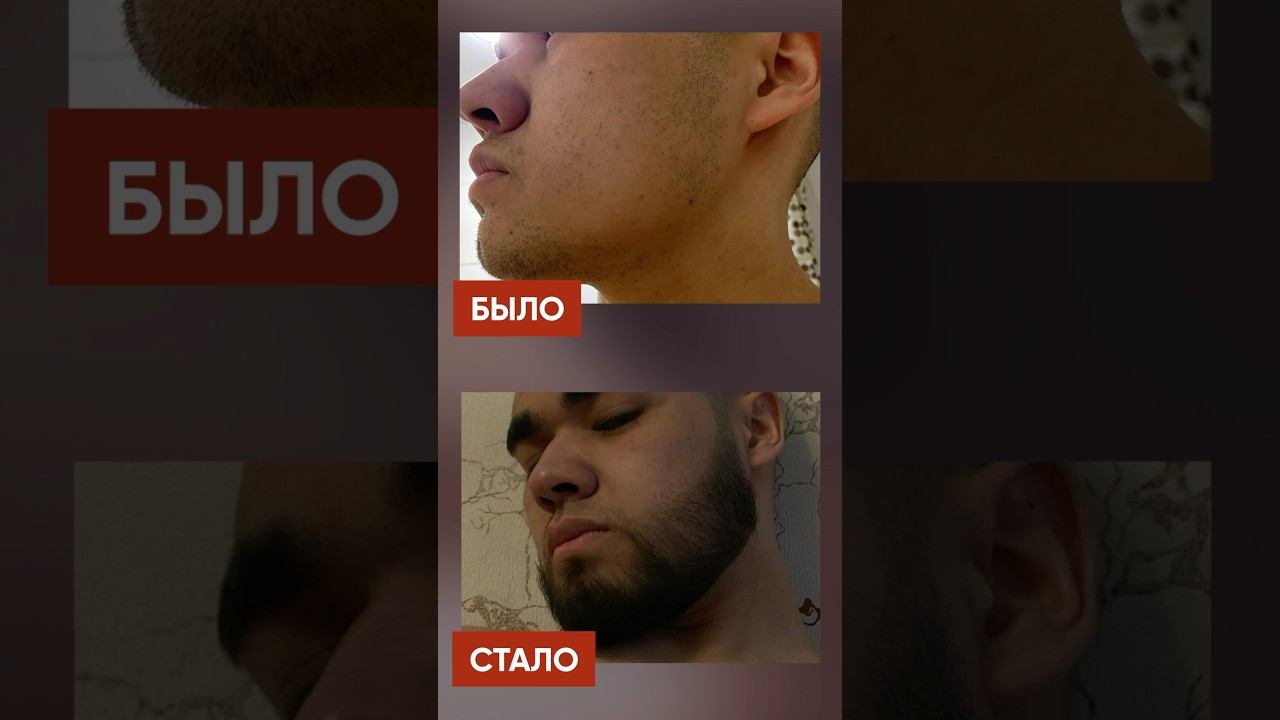 СЛЕДОВАЛ инструкциям и вот что из этого вышло! Средство для роста бороды смотреть онлайн