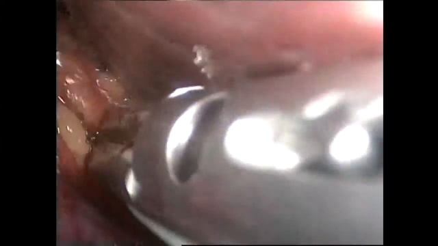 Laparoscopic rigth nephrectomy Лапароcкопическая нефрэктомия справа смотреть онлайн