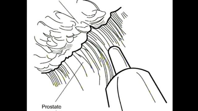 Dr. Aho Гольмиевая лазерная энуклеация предстательной железы (HoLEP) смотреть онлайн