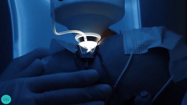 Лазерное коррекция зрения ReLEx SMILE смотреть онлайн