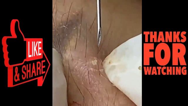 Blackheads Remove,pimples Removal,acne Removal Treatment,dr Pimple Popper Nose 2021 #11