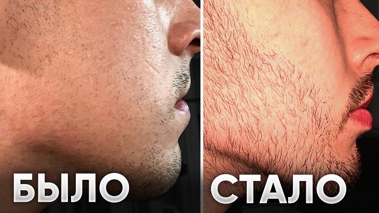 Результаты после 6 месяцев использования Ксиноксина: что получилось? смотреть онлайн