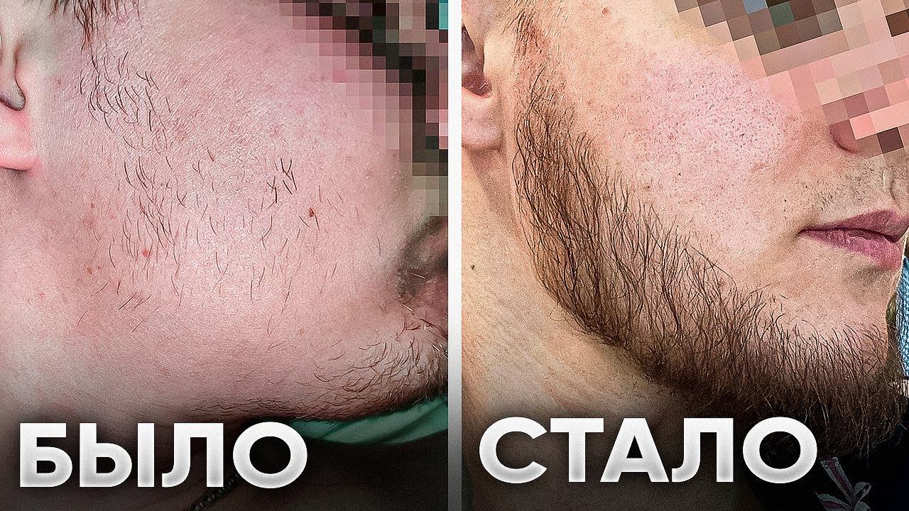 от ПАЦАНА до БРУТАЛА за 5 месяцев! Результаты средства для роста бороды смотреть онлайн