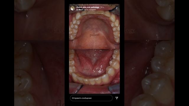 Осмотр слизистой оболочки полости рта.Precancerous lesions.Хирургическая стоматология Онкология СОП смотреть онлайн