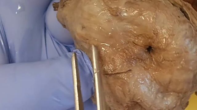bladder preparation explanation смотреть онлайн