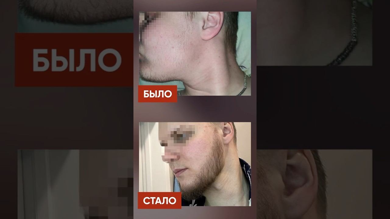 За 5 месяцев отрастил ГУСТУЮ бороду! Средство для роста бороды смотреть онлайн