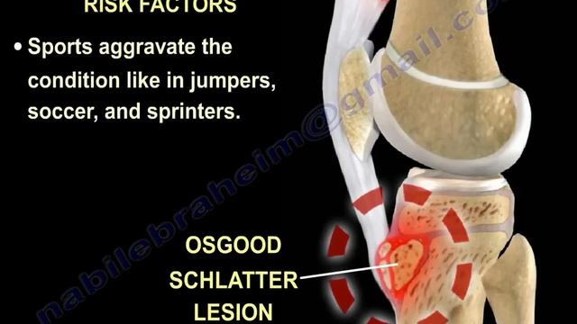 Osgood Schlatter Disease - Everything You Need To Know - Dr. Nabil Ebraheim смотреть онлайн