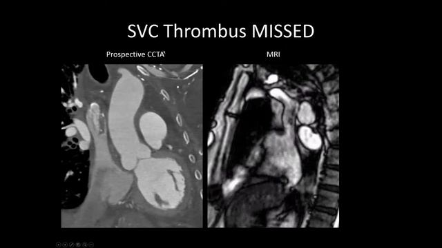 2017 01 18 WFLHCA Case #45 - Multimodal CCTA Imaging in the Evaluation of CVD смотреть онлайн
