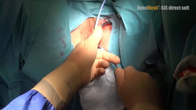 DynaMesh®-SIS direct soft - OR-Video: Treatment of Stress and Mixed Urinary Incontinence смотреть онлайн