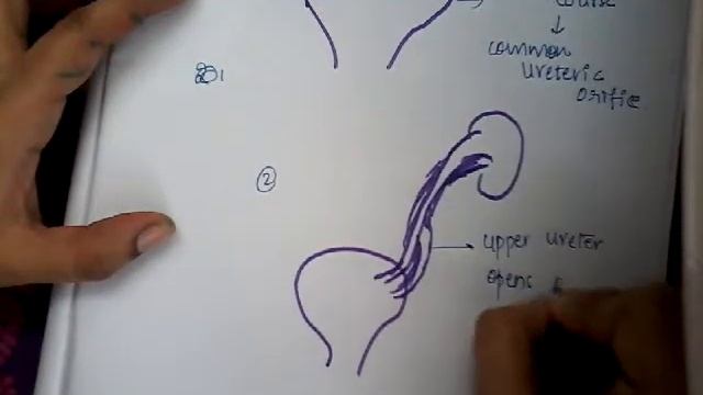 Horseshoe kidney || kidney || renal смотреть онлайн
