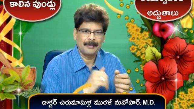 Burns | Sure Cure | Telugu | Dr. Murali Manohar Chirumamilla, M.D. | Ayurveda смотреть онлайн