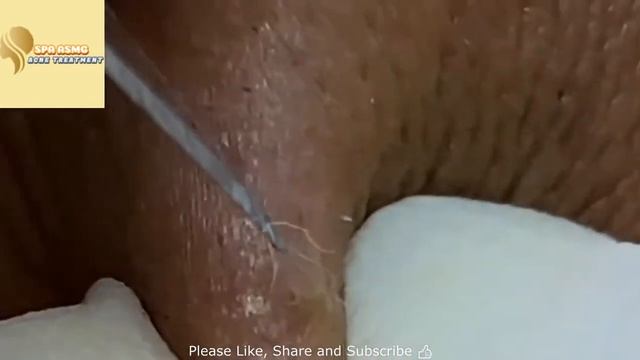 BIG Blackheads Removal Acne Treatment SPA ASMG Blackheads Выдавливание черных точек смотреть онлайн