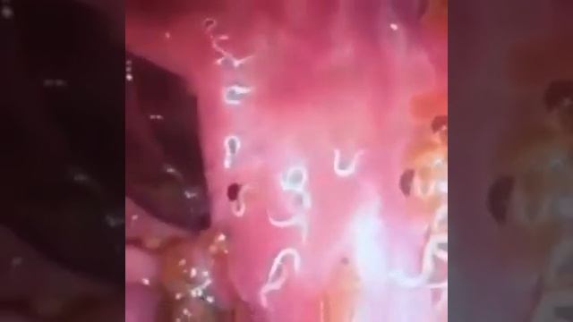 !!! Паразиты в кишечнике. Это нужно искоренять смотреть онлайн