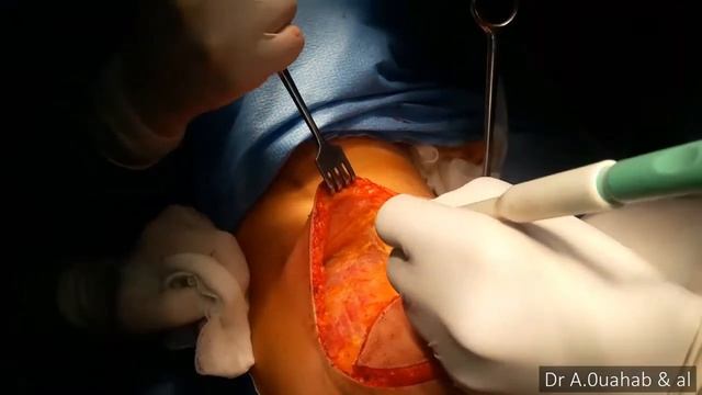 Unilateral Breast reconstruction with Latissimus Dorsi Flap and Implant смотреть онлайн
