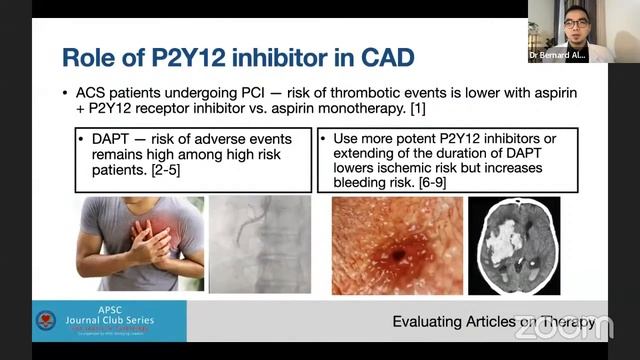 Role of P2Y12 inhibitor therapy in ACS and after PCI: Twilight and ISAR-React 5 смотреть онлайн