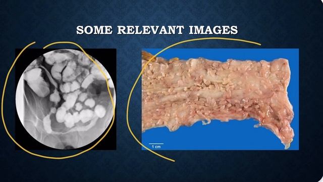 Listen To The Ultimate Inflammatory Bowel Disease Podcast! смотреть онлайн