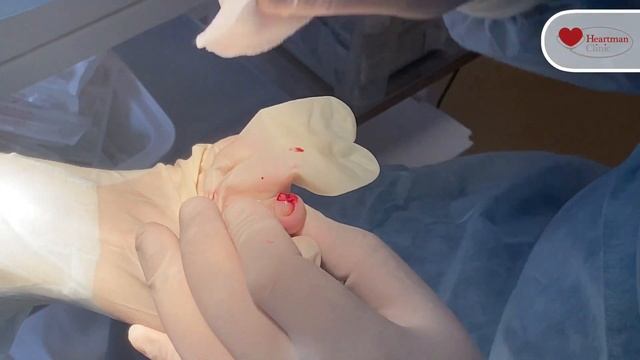 Операция новообразования ногтевой фаланги. смотреть онлайн