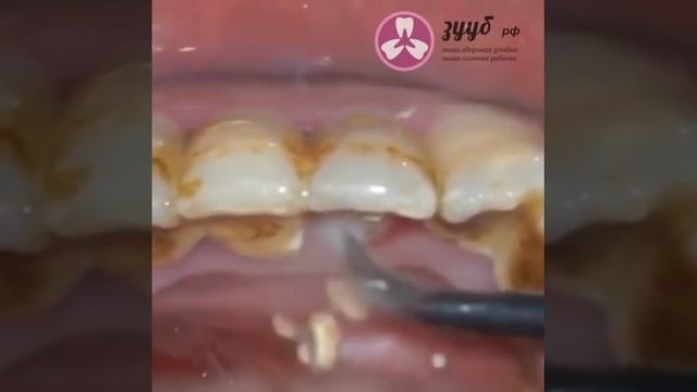 Ультразвуковая чистка зубов в клинике Зууб.РФ смотреть онлайн