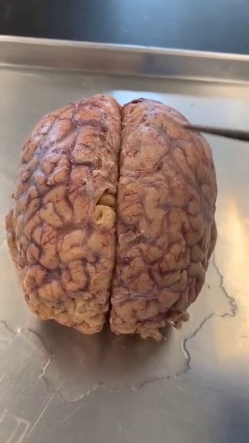 Longitudinal fissure of the brain 🧠 #medical #medicalprofessionals смотреть онлайн