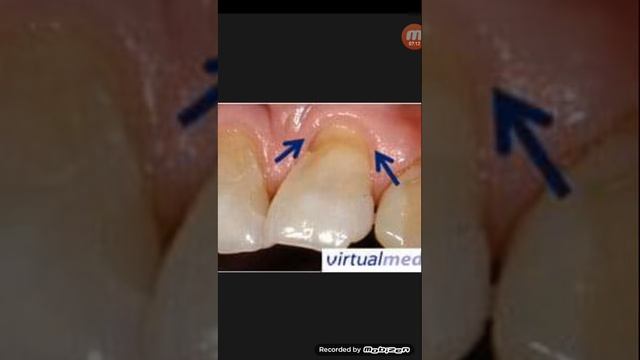 Teeth সেনসিভিটি কি?কেনো হয় এবং এর চিকিৎসা... смотреть онлайн