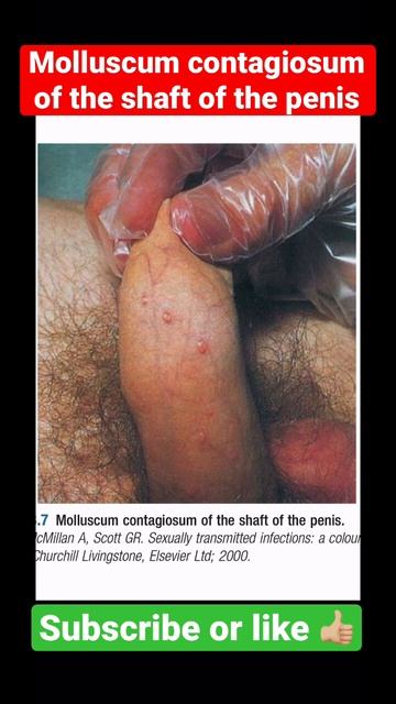 Molluscum contagiosum of the shaft of the penis смотреть онлайн