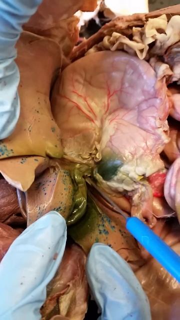 liver, gall bladder, hepatic duct, cystic duct, common bile duct, pancreas смотреть онлайн