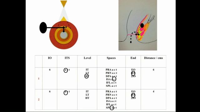 Fistula in Ano III FIA Classification смотреть онлайн