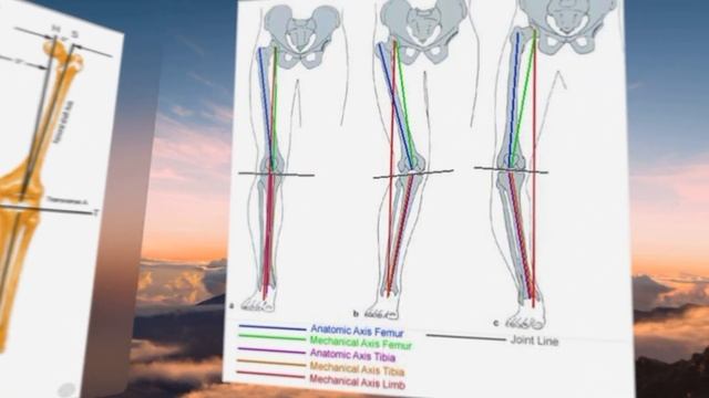 Understanding the Varus/Valgus Knee Alignment смотреть онлайн