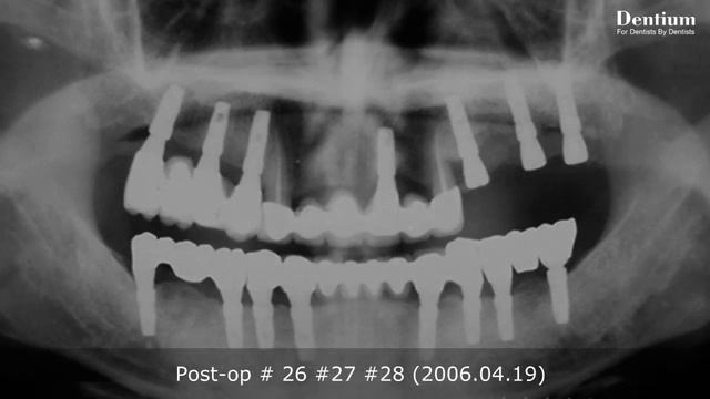 Implantium 10 years case смотреть онлайн