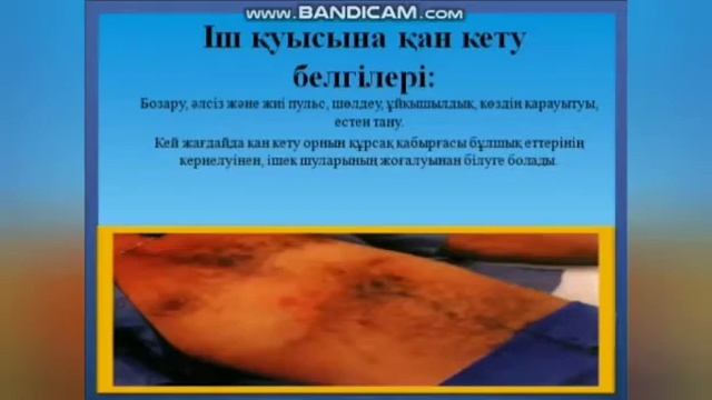 Иманбек Б.К. Қан кету кезіндегі алғашқы медициналық көмек смотреть онлайн