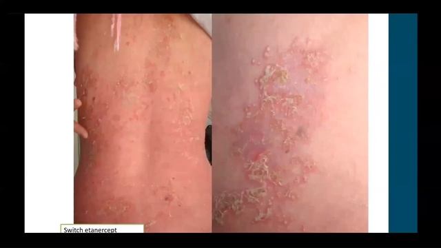 Webinaire Génodermatoses смотреть онлайн