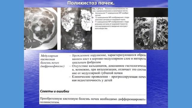 Заболевания почек часть 3 смотреть онлайн