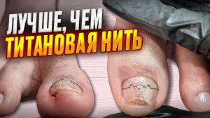Установка коррекционной системы 3ТО | Лучше, чем титановая нить | Скрученные ногти
