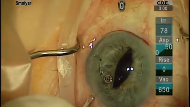 Iris Sutured IOL . Complicated cataract surgery. Операция катаракты. смотреть онлайн