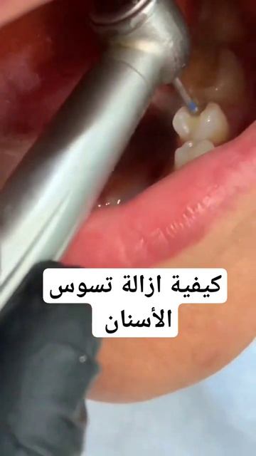 كيفية ازالة تسوس الاسنان смотреть онлайн