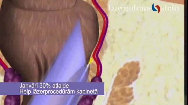 Dr Maurina klinika Proktologija смотреть онлайн