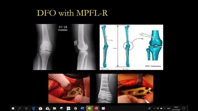 Nagpur Arthroscopy Meeting2020 Patellofemoral instability Dr.Bancha Chernchujit Thailand смотреть онлайн