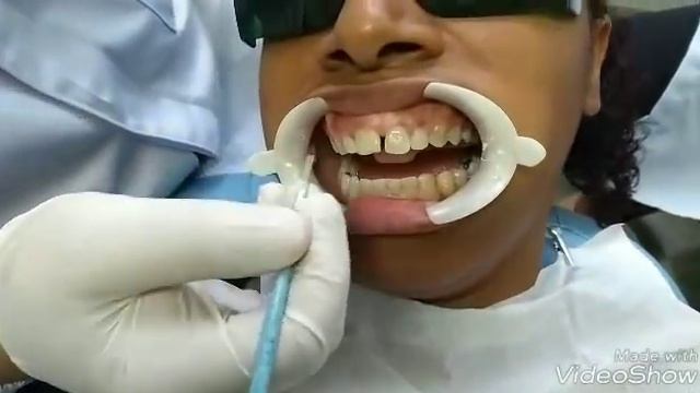 Caso clinico de fechamento de diastema com material da 3 M. смотреть онлайн