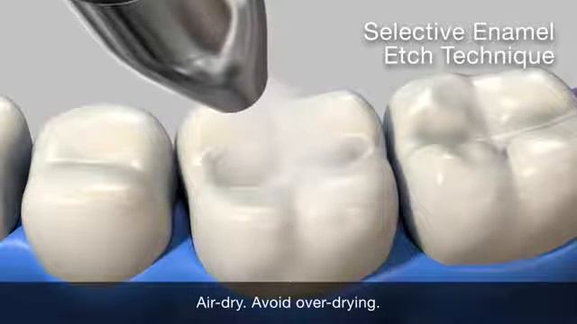 Gluma Bond Universal Different type of etching-www.SmileDentalStore.com смотреть онлайн