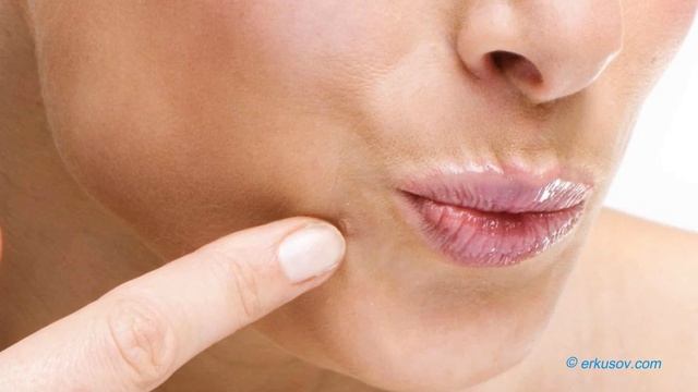 Ինչպես ազատվել պապիլոմաներից՝ բնական միջոցներով смотреть онлайн