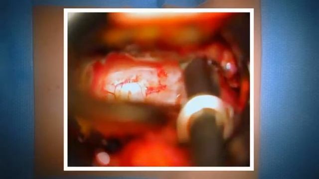 Minimal-invasive TLIF смотреть онлайн