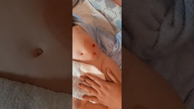Stoma Bag application for babies. Anal Rectal Malformation. смотреть онлайн