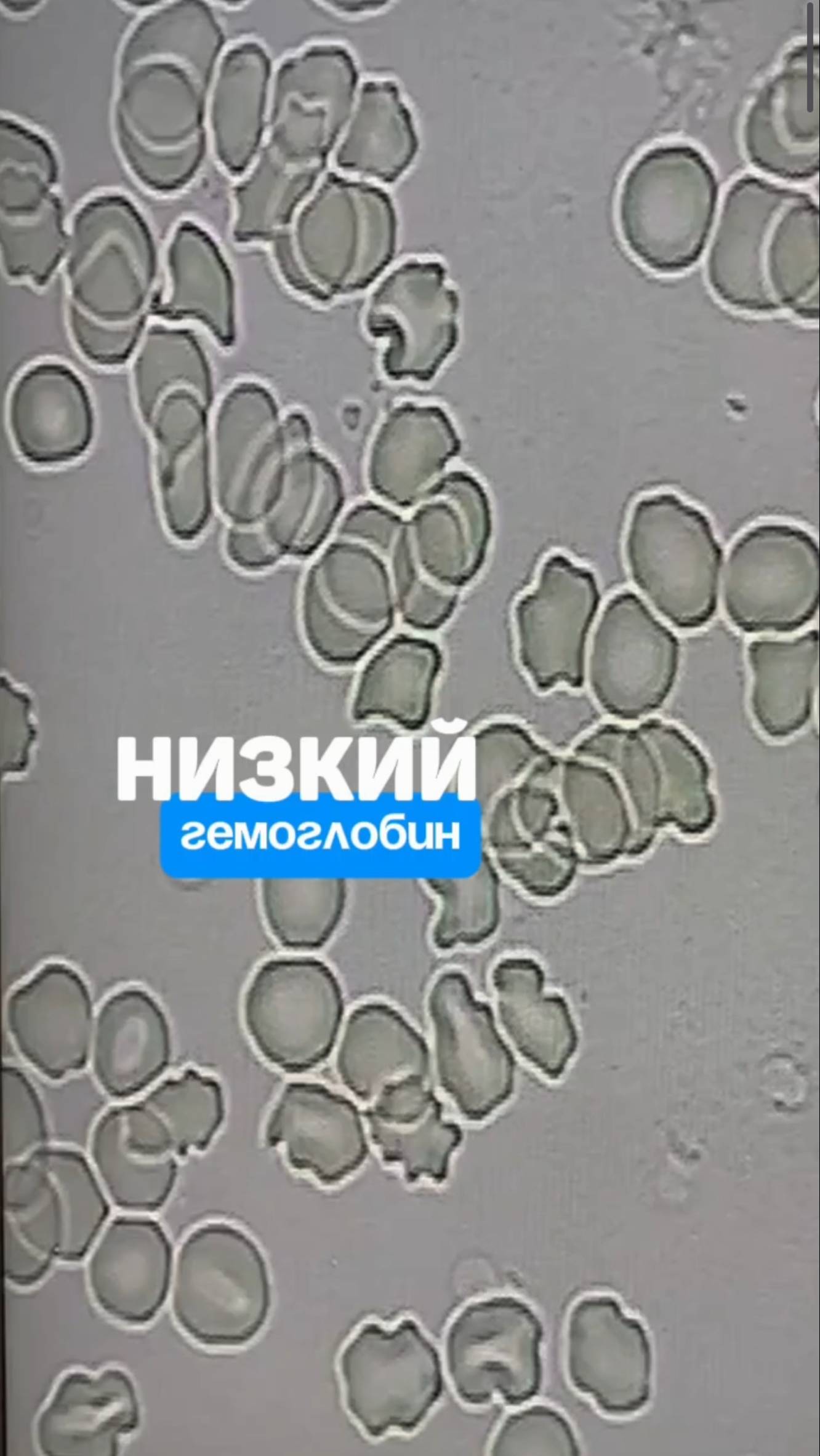 Если гемоглобин низкий, ваша кровь выглядит так. Алена Братишко смотреть онлайн