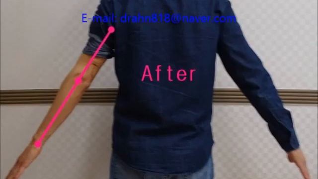 Cubitus varus surgery(elbow varus deformity) by Dr. Ahn смотреть онлайн