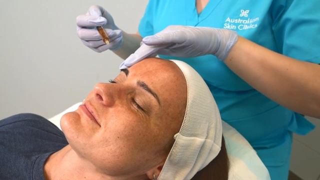 Meso-needling Treatment at Australian Skin Clinics смотреть онлайн