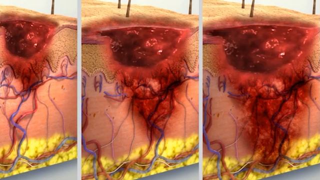 What Happens In Skin Cancer? | Symptoms, Causes and Treatment (Urdu/Hindi) смотреть онлайн
