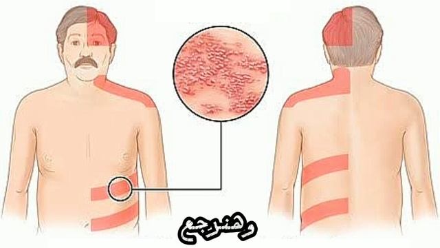 علاج فيروس الحزام الناري بالأعشاب والزيوت الطبيعية في أسرع وقت смотреть онлайн