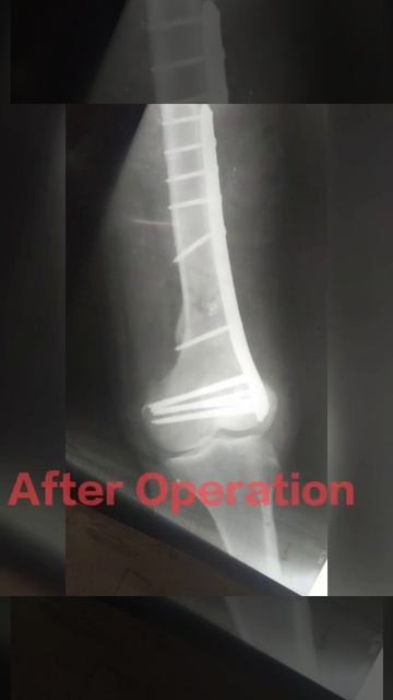 Distal Femur Fracture Plating #bestorthopedicsurgeon #bestdoctoringujarat #bestdoctorinahmedabad смотреть онлайн