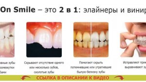 SNAP ON SMILE ИНСТРУКЦИЯ ⚫ ПОСТАВИТЬ ВИНИРЫ В БРЯНСКЕ