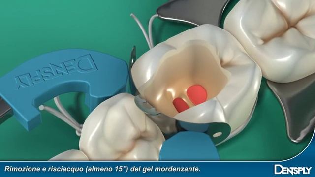 DENTSPLY Endo-Resto System смотреть онлайн